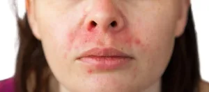 Dermatitis Kontak di Wajah