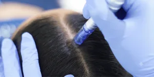 Prosedur Exosome Hair Treatment