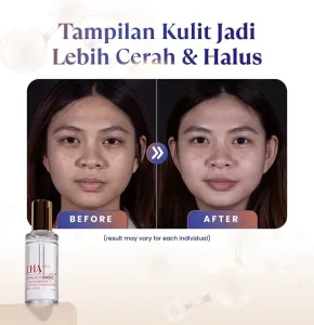 Hasil Treatment LHALA Peel Sozo Skin Clinic