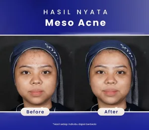 Hasil Before dan After Meso Acne di Sozo Skin Clinic