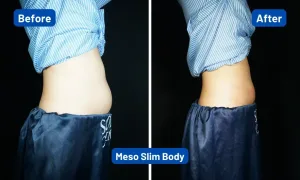 Hasil Meso Slim Body di Sozo Skin Clinic