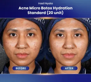 Hasil Micro Botox Treatment di Sozo Skin Clinic