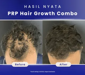 Hasil Before dan After PRP Hair Treatment di Sozo Skin Clinic