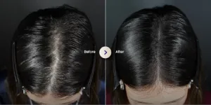 Hasil PRP Hair Treatment di Sozo Skin Clinic