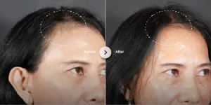 Hasil Hair Treatment di SOZO Skin Clinic