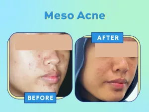 Hasil Perawatan Jerawat di SOZO Skin Clinic