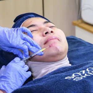 Prosedur Micro Botox di Sozo Skin Clinic