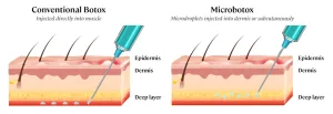 Perbedaan Micro Botox dan Botox Konvensional | Sumber: Bay Aesthetics Clinic and Medispa