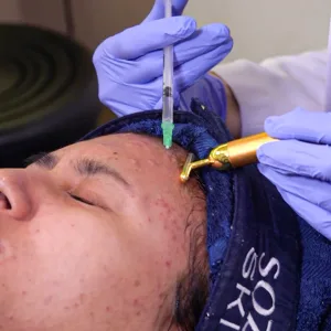 Prosedur Meso Acne di Sozo Skin Clinic