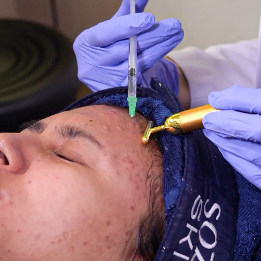 Apa Itu Meso Acne? Manfaat & Prosedur untuk Jerawat Meradang
