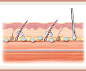 Prosedur Micro Botox