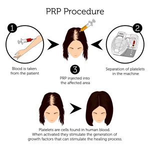 Prosedur PRP Rambut