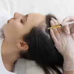 Apa Itu PRP Rambut? Cek Manfaat, Biaya, & Efek Sampingnya!