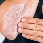 Psoriasis: Penyebab, Gejala, Jenis, dan Pengobatan
