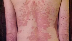 Psoriasis Eritrodermik