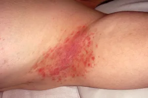 Psoriasis Inversa