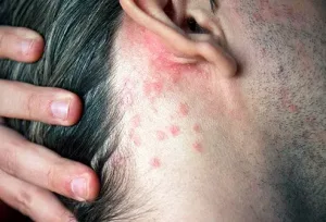 Psoriasis Gutata