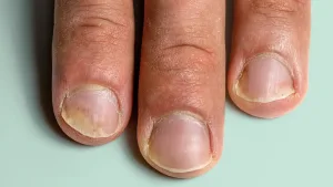 Psoriasis Kuku
