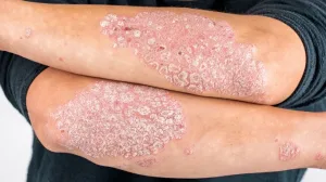 Psoriasis Plak