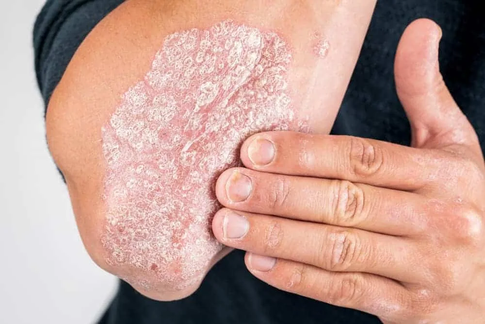Psoriasis: Penyebab, Gejala, Jenis, dan Pengobatan