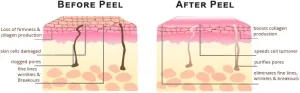 Ilustrasi Cara Kerja Glycolic Acid