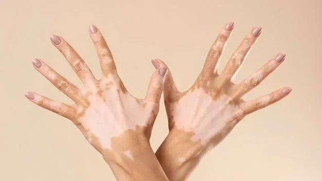 Vitiligo: Penyebab, Gejala, Jenis & Cara Mengatasi