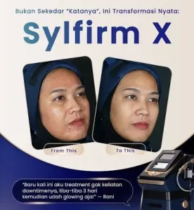 Hasil Sylfirm X di SOZO Skin Clinic