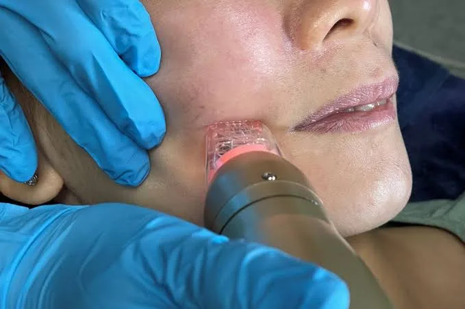 Sylfirm X Gabungkan RF dan Microneedling, Apa Bedanya dengan Skin Booster?