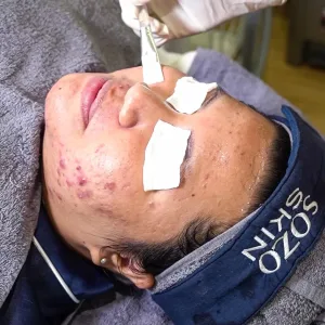 acne peel treatment