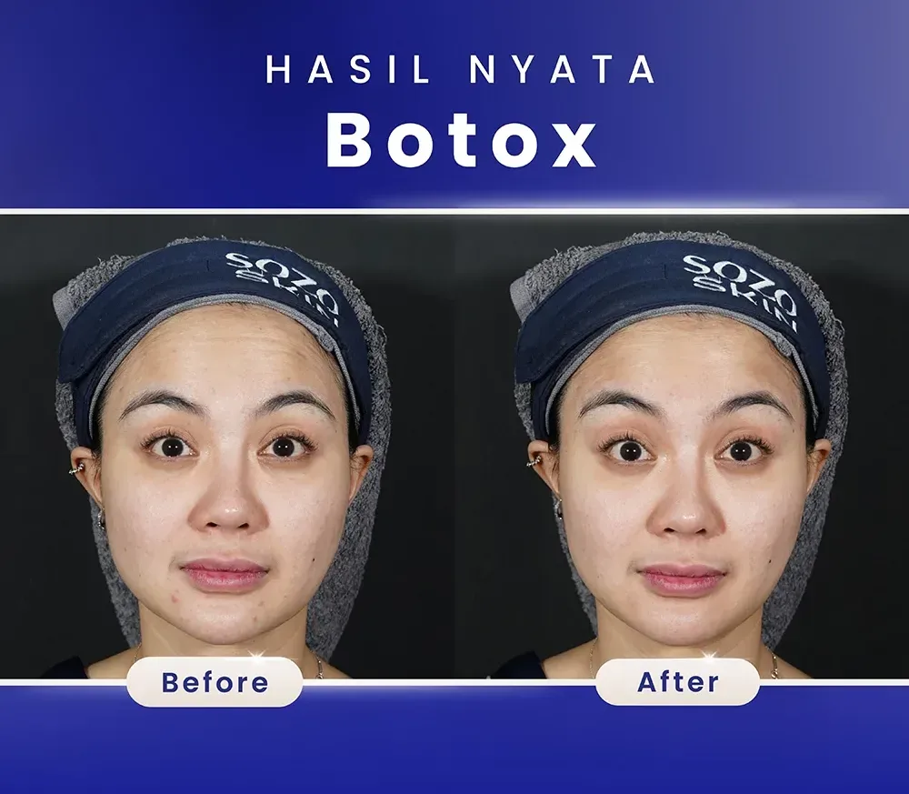 before after botox treatment