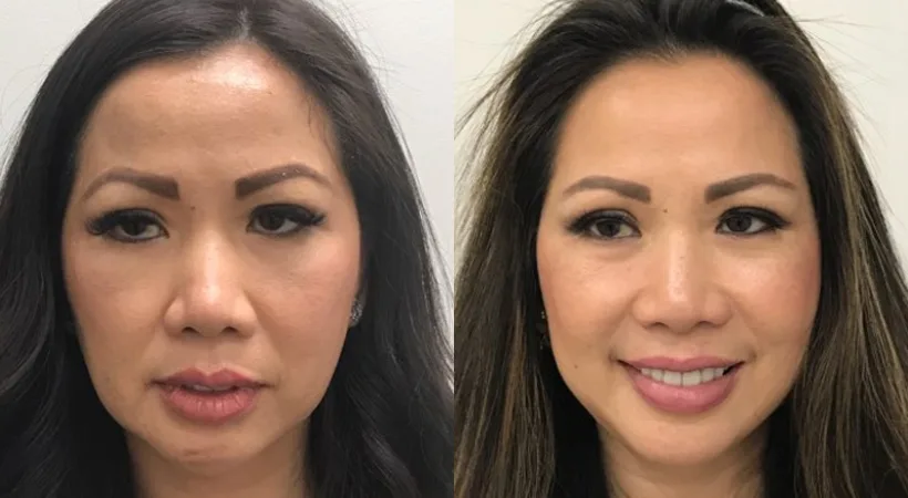 before after perfect facelift