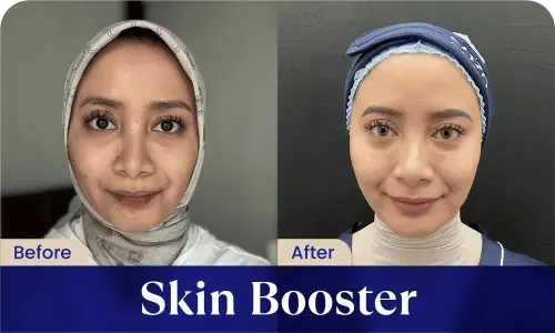 before after skin booster
