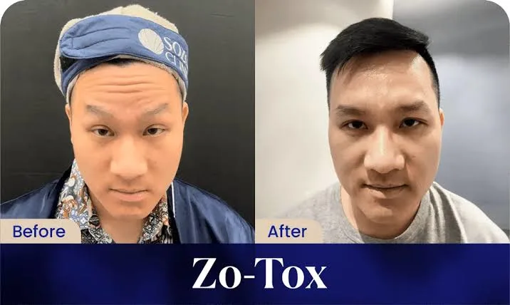 before after zo tox 10u