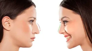 Ilustrasi Hasil Nose Job