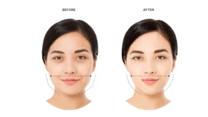Cara Kerja Botox Masseter