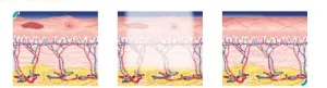Cara Kerja IPL Glow | Sumber: Dr Karen Horton