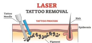 Cara Kerja Laser Tattoo Removal