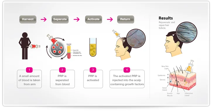 cara kerja prp hair treatment
