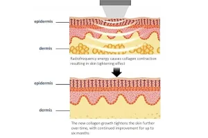 Cara Kerja Radiofrequency