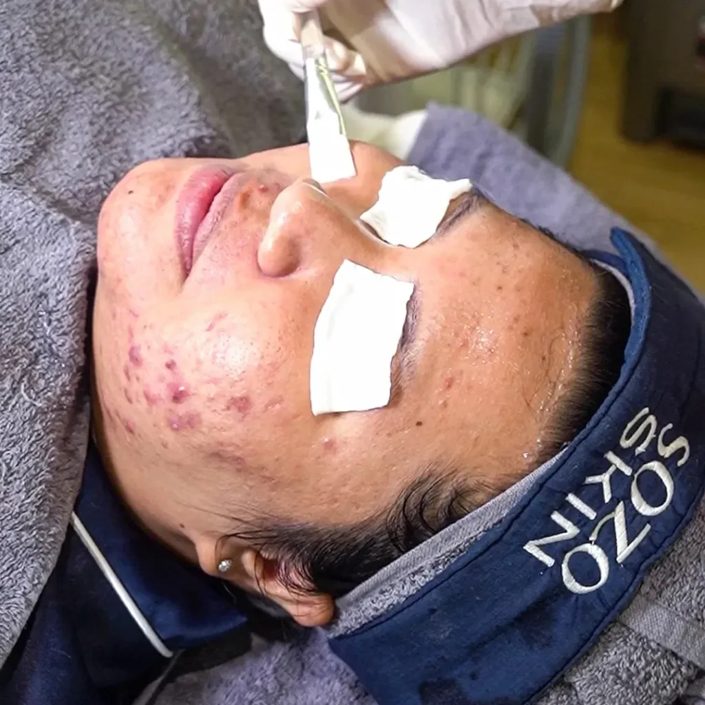 acne chemical peel