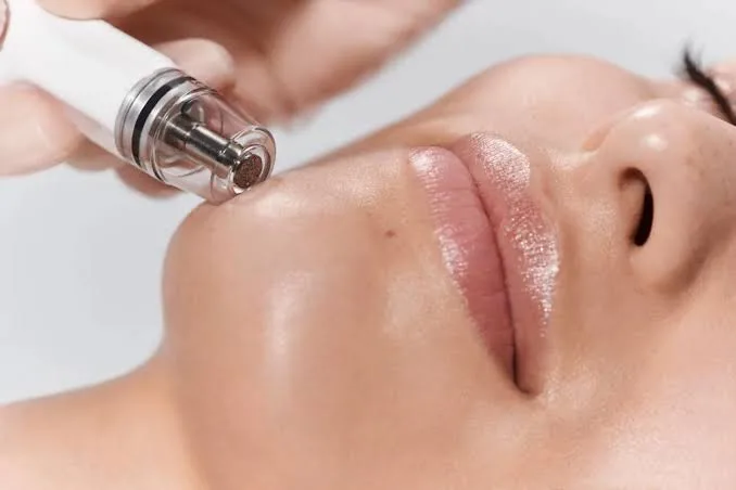 Pori-Pori Besar Bikin Tekstur Kasar? Kenali Diamond Laser Facial