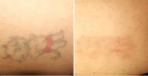 Contoh Kasus Ghosting setelah Laser Tattoo Removal