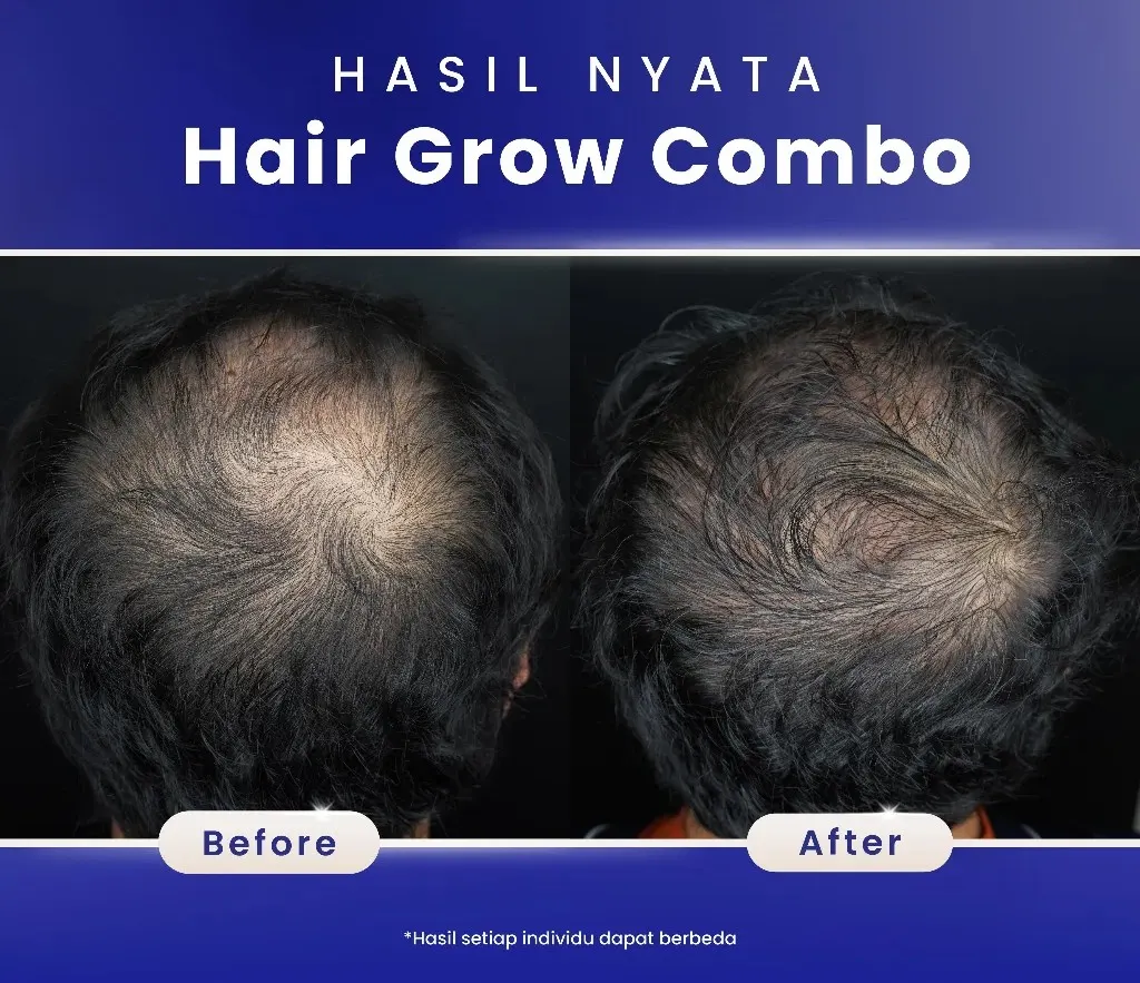 before after hair grow treatment