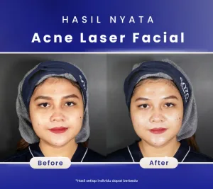 Hasil Acne Laser Facial