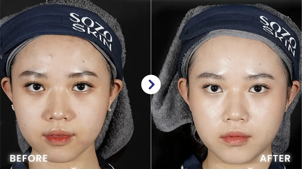Hasil Derma Peel