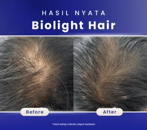 Hasil Biolight Hair Theraphy