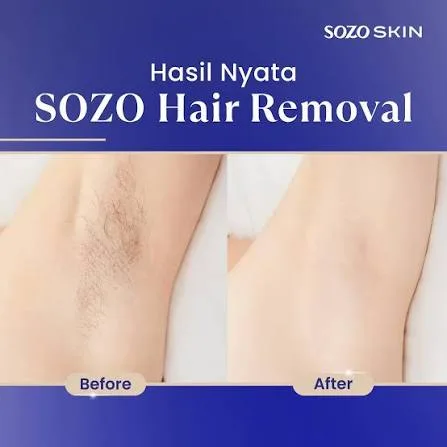 hasil body hair removal laser