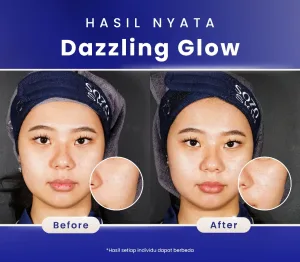 Hasil Dazzling Glow Peel