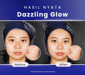 Hasil Dazzling Glow Peel