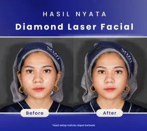 Hasil Diamond Laser Facial